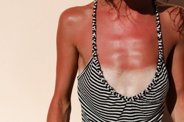 Izgoreli ste na suncu? Ovim trikom možete da smanjite bol i opekotine